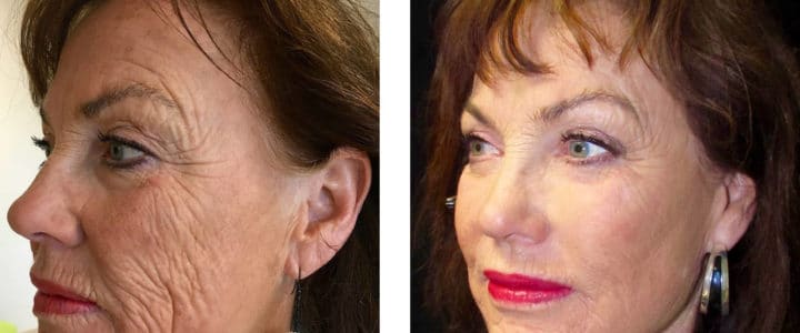 Ansiktslyft samt Needlepen profil