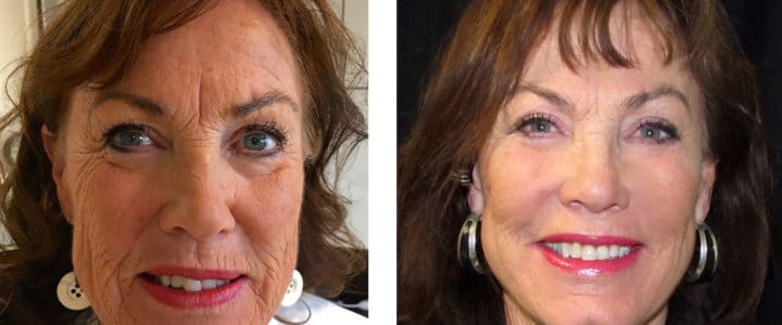 Ansiktslyft samt Needlepen