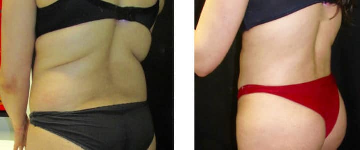 Brazilian buttlift profil