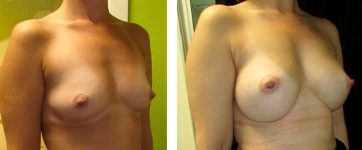 Bröstförstoring halvprofil-320cc