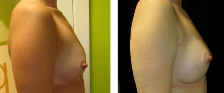 Bröstförstoring profil-320cc