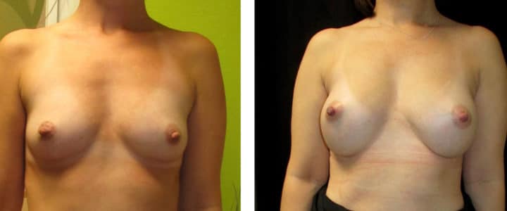 Bröstförstoring-320cc