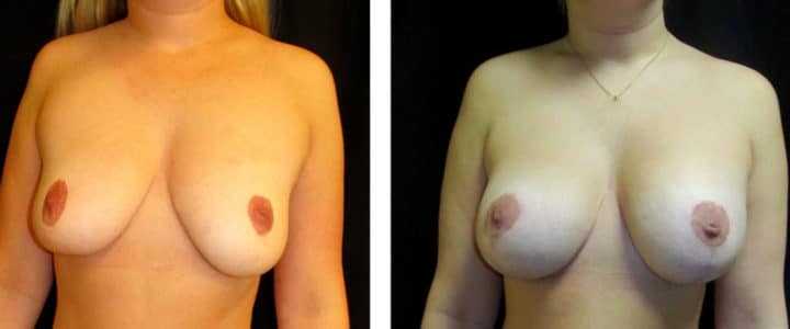 Bröstförstoring samt lyft-225cc