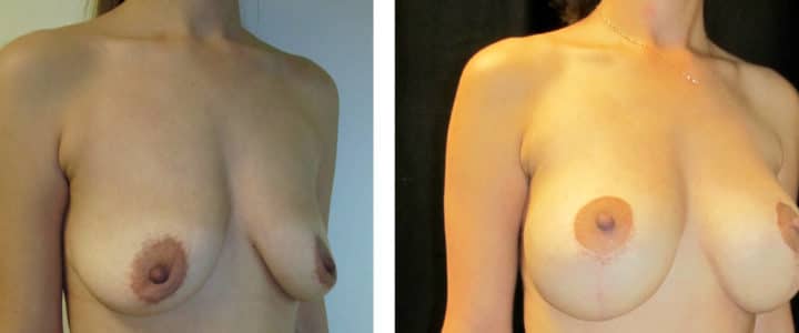 Bröstförstoring samt lyft halvprofil-345cc