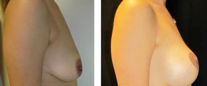Bröstförstoring samt lyft profil-345cc