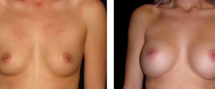 Bröstförstoring-350cc