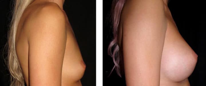 Bröstförstoring Profil-350cc