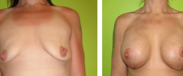 Bröstförstoring samt lyft-500cc