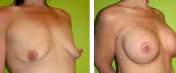 Bröstförstoring samt lyft halvprofil-500cc