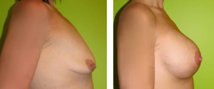 Bröstförstoring samt lyft profil-500cc