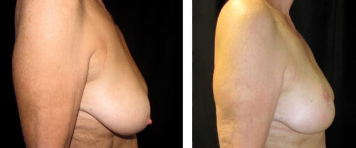 Bröstreduktion samt lyft profil
