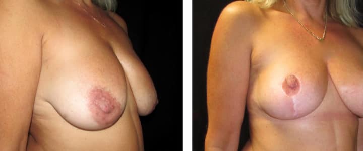 Bröstreduktion med lyft profil