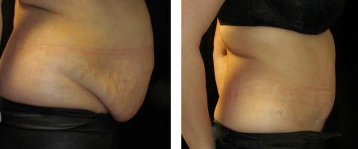 Bukplastik – profil